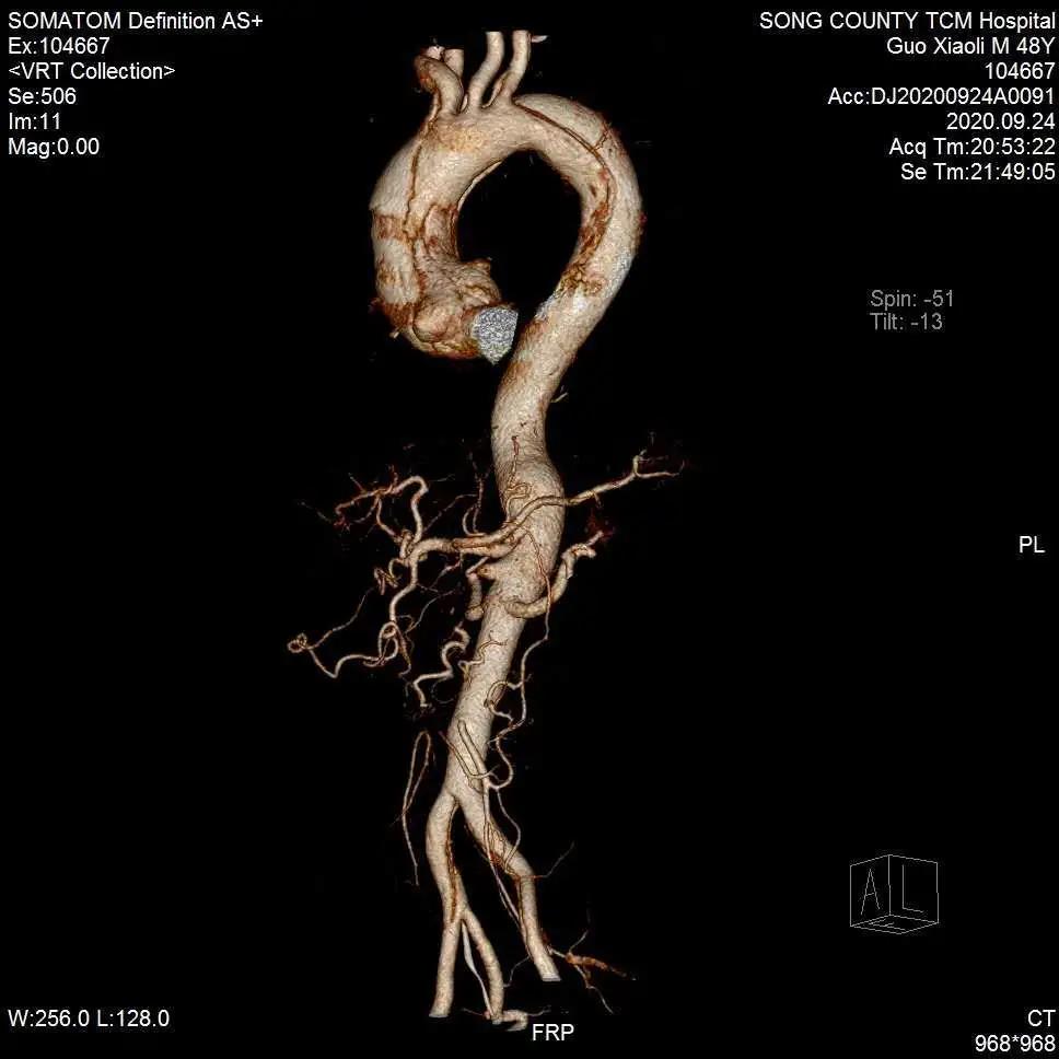肠系膜上动脉夹层图片